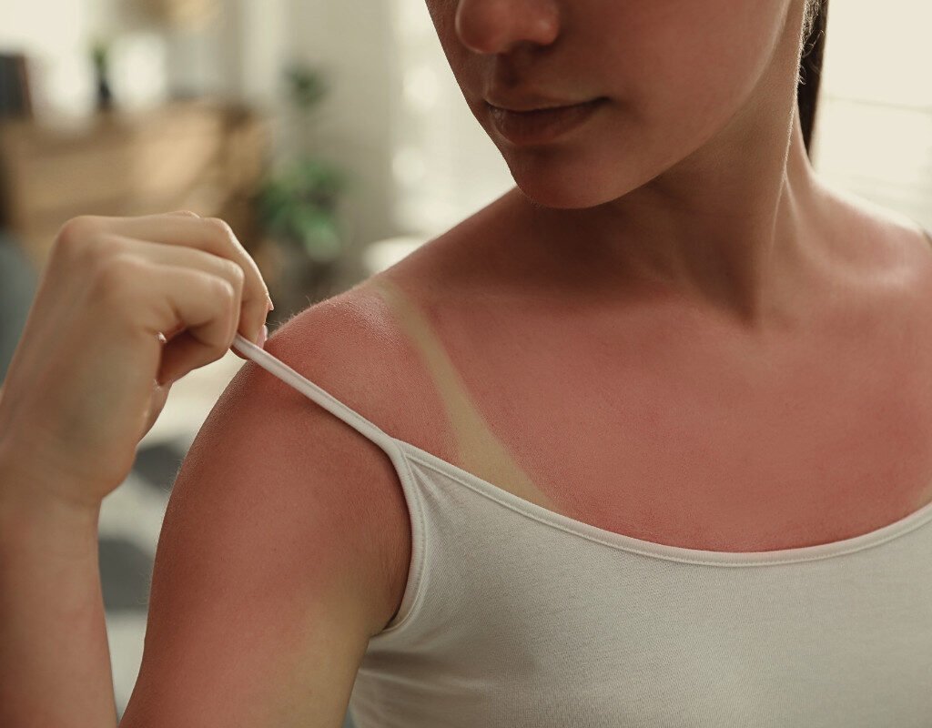 Sunburn Relief in Bali: Cooling Spa Treatments for Overexposed Skin by My Bali Healing